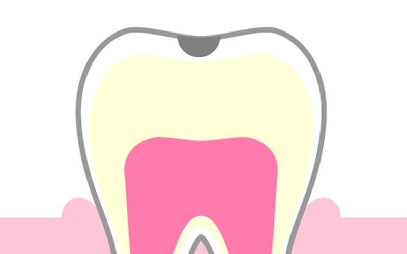 エナメル質の虫歯