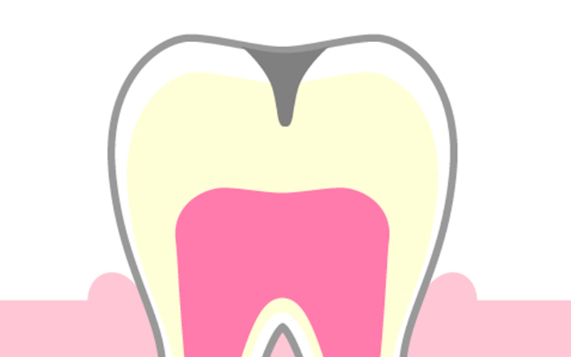 象牙質に達した虫歯