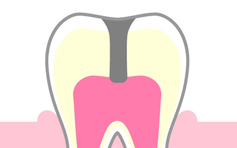 歯髄に達した虫歯