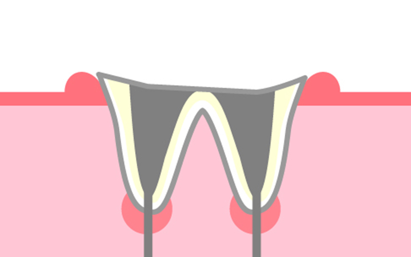 歯質が失われた虫歯